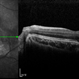 Juxtafoveal Choroidal Neovascularization Secondary to Choroidal Rupture Juxtafoveal Choroidal Neovascularization Secondary to Choroidal Rupture